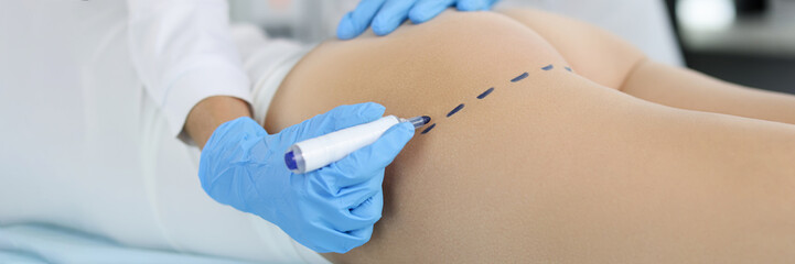 Doctor making preoperative marking on patient buttocks closeup