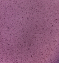 Semen analysis, sperm analysis on microscopic examination, Normozoospermia, normal semen analysis