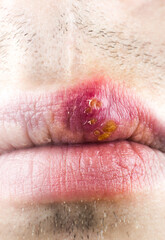 Fototapeta premium Herpes labialis on the lip of a Caucasian man. Face close-up..Сold sores illness disease. Simplex virus.
