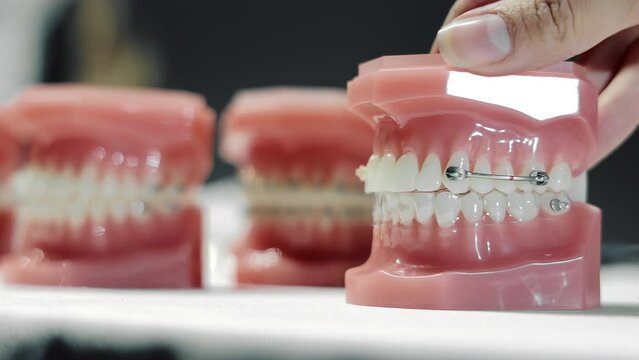 Model of the tooth gap on the placement of orthodontic brackets. Variants of placement and fixing of orthodontists on different layouts. Dental Anomaly
