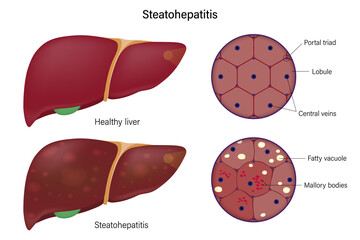 Liver histology. Normal liver and steatohepatitis. Liver disease for medical education and science.
