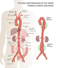 The arch and branches of the aorta. Thoracic aortic aneurysm - obrazy, fototapety, plakaty