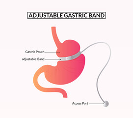 adjustable gastric band, Lap Band Surgery Diagram Medical illustration.