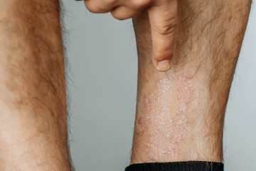 Acute psoriasis na is an autoimmune incurable dermatological skin disease. A large red inflamed...