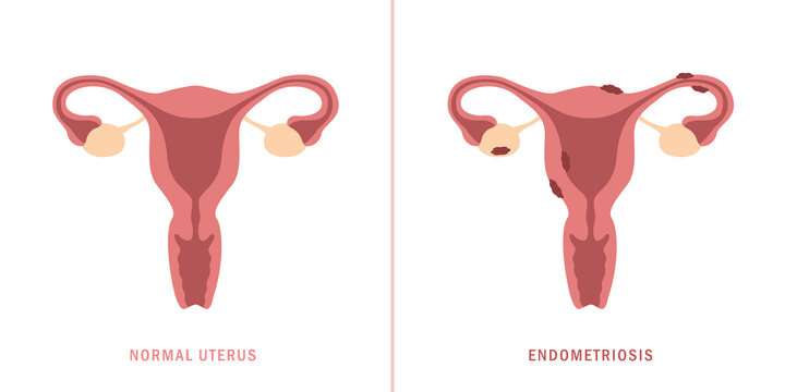 endometriosis and normal uterus womens health anatomy info graphic