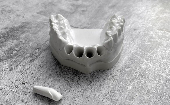 Plaster model of Geller for the manufacture of dental veneers, crowns and implants on a gray background. The concept of a dental clinic, dental laboratory.