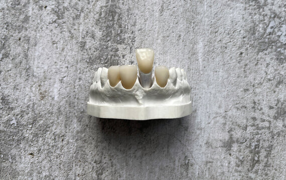Dental veneers on a demountable model in the laboratory. Collapsible dental model for dental prostheses, metal ceramics, metal-free ceramics, model from refractory gypsum according to Geller