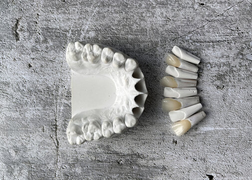 Model from refractory gypsum according to Geller. Manufacture of dental veneers, crowns and implants in a dental clinic, dental laboratory.
