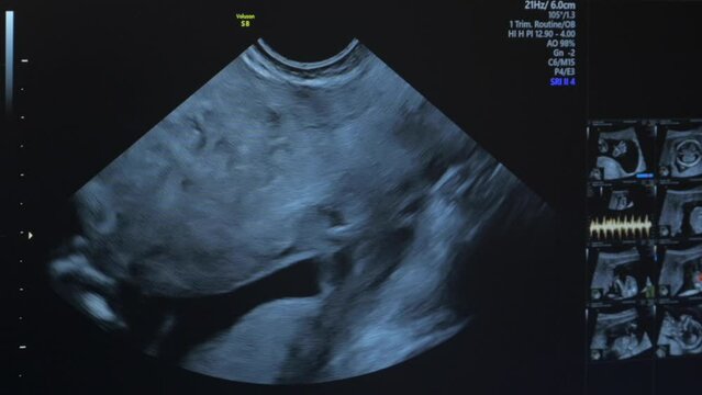 Ultrasonography of pregnant woman. Baby in mothers womb, 14 weeks of life. Human embryo on an ultrasound display.