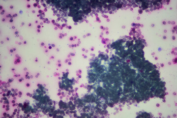 Poorly differentiated thymus mediastinal carcinoma stain sample.