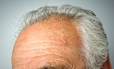 bald mans head