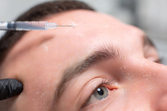 Close up of a drop of a drug falling from a syringe needle on the forehead of a male patient of a cosmetology office. Rejuvenation procedure, botox injections against facial wrinkles
