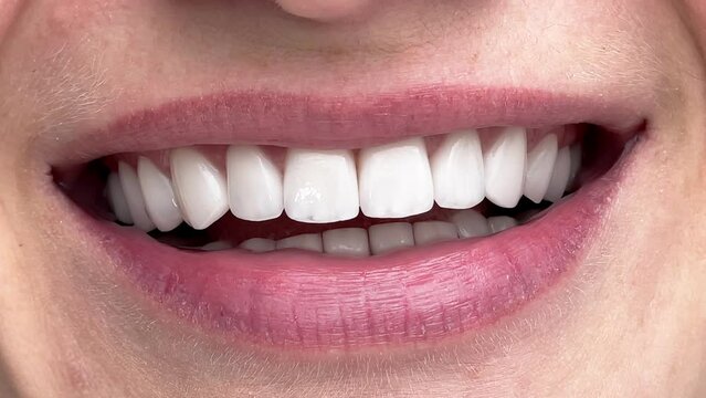 Perfect white teeth close up, female veneer smile, dental care and stomatology, dentistry