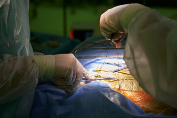 Fototapeta na wymiar the hands of the surgeon and the assistant sew up the wound with long threads after the operation