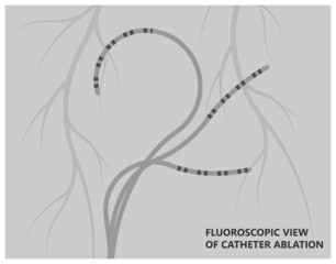minimally invasive procedure attack Cardiac catheter ablation Atrial fibrillation rhythm problem cath lab treat treatment Coronary x-ray Radio frequency Sinus Ventricular SVT ECG ICD Radiofrequency AV
