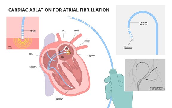 Atrial Fibrillation Minimally Invasive Procedure Attack Cardiac Catheter Ablation Rhythm Problem Cath Lab Treat Treatment Coronary X-ray Radio Frequency Sinus Ventricular SVT ECG ICD Radiofrequency AV