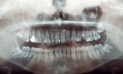 panoramic x-ray of teeth. problem teeth. dental clinic. close-up.treatment of diseased teeth.