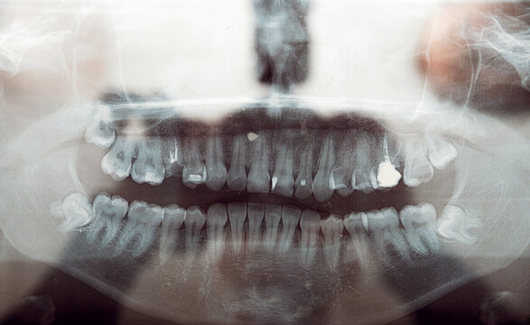 panoramic x-ray of teeth. problem teeth. dental clinic. close-up.treatment of diseased teeth.