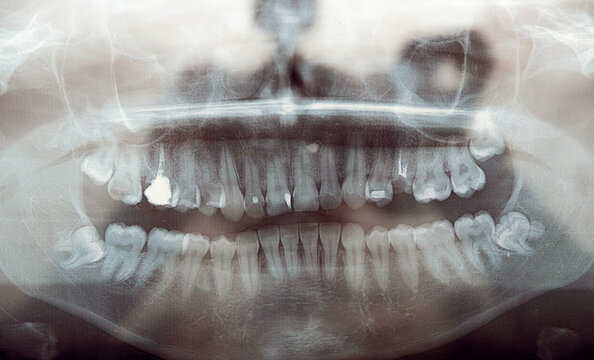 panoramic x-ray of teeth. problem teeth. dental clinic. close-up.treatment of diseased teeth.