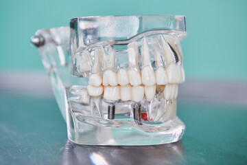 Transparent Model of a human jaw showing teeth, roots, gums, gum disease, caries and plaque.