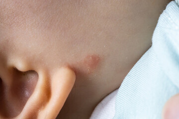 atopic eczema dermatitis skin condition on unknown baby close up