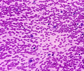 Atypical cells, smear show mostly regular oval to spindle shaped cells, mild pleomorphism,...
