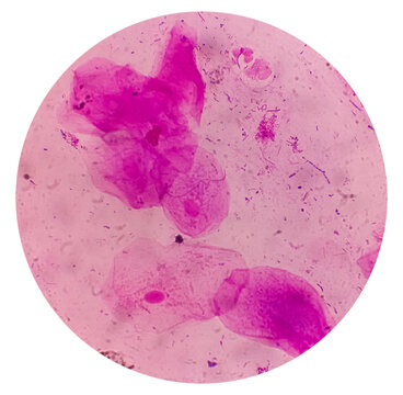 Gram stain: Epithelial cells, Gram negative rod, Gram positive cocci, 40x microscopic view