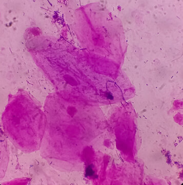 Gram stain: Epithelial cells, Gram negative rod, Gram positive cocci, 40x microscopic view