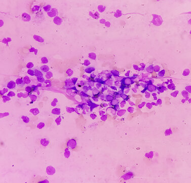 Chronic myeloid leukemia(CML) is a type of blood cancer. show the increased and unregulated growth of myeloid cells, mononuclear cells in blood smear.