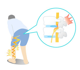 Illustration of lumbar disc herniation