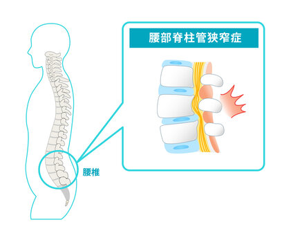 腰部脊柱管狭窄症の図解イラスト