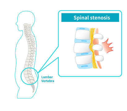 Illustration of lumbar spinal canal stenosis
