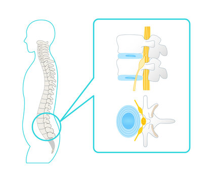 Illustration of a healthy lumbar spine Vertebrae and sciatic nerve