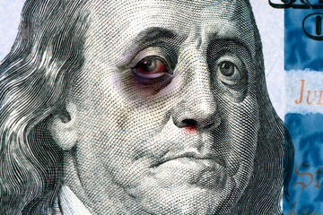 Benjamin Franklin on a 100 us bill with a black eye. The concept of the economic crisis in United States. Inflation dollar. Refusal of international dollar settlements - obrazy, fototapety, plakaty