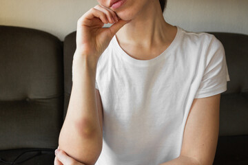 Young woman in white t-shirt with large bruise on arm. Victim of domestic violence.