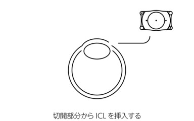 ICL（眼内コンタクトレンズ）手術、ICL挿入の図解
