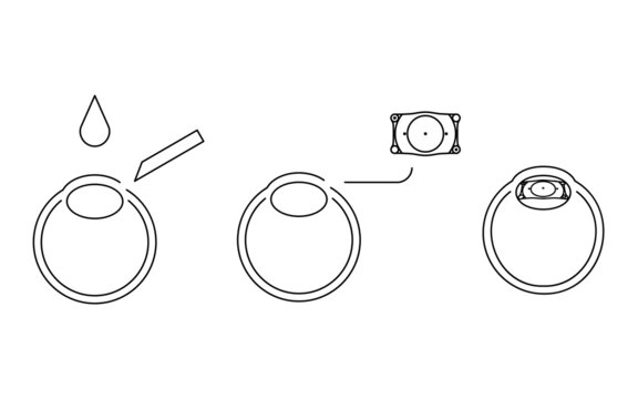 ICL（眼内コンタクトレンズ）手術、図解