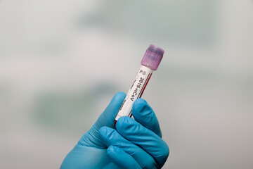 Naklejka premium Close up of hands in medical gloves holding a test tube after coronavirus analysis with result markers