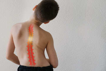 naked back of boy, child 8-10 years old grabbed a sore spot, curved spine, red spot as symbol of...