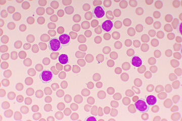 Picture of acute lymphocytic leukemia or ALL cells in blood smear, analyze by microscope, 1000x