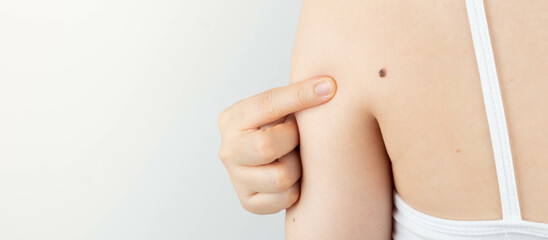 Young woman pointing at dark brown moles on her back for self-exams skin. Being aware of changes in your moles to detecting skin cancer, especially malignant melanoma. Skin disease concept. - obrazy, fototapety, plakaty