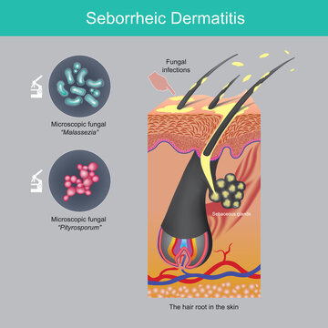 Seborrheic Dermatitis. Scalp fall of sheets problem caused by sebaceous glands in hair roots skin and fungi on scalp..