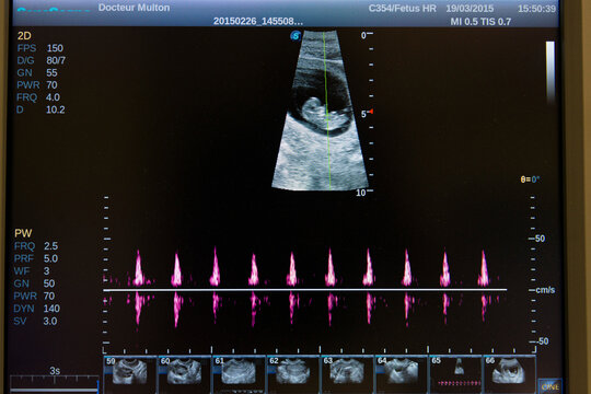 Echographie d'une femme enceinte