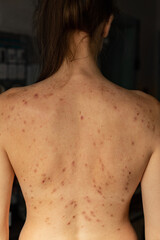 Acne problem concept. Teenage girl with problem skin on her back with pimples and rash - obrazy, fototapety, plakaty