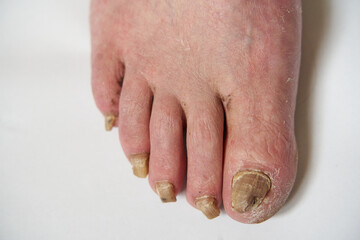 closeup of a foot with arthritis, damaged nails because of fungus