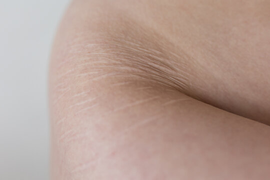 Woman with stretch marks on skin