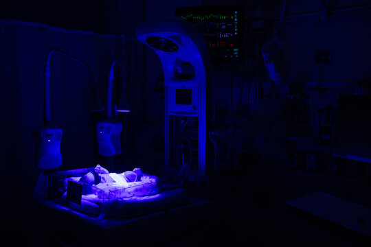 Infant in NICU under phototherapy
