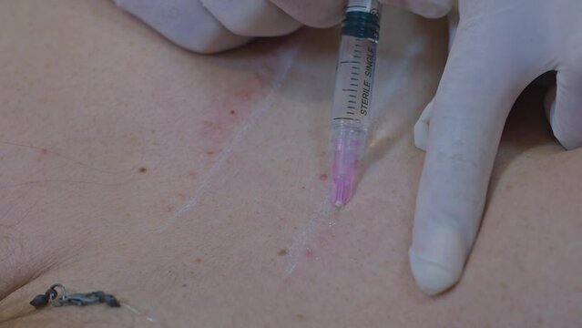 Beauty and injection concept. Cosmetology in the clinic. An experienced beautician wearing white gloves injects subcutaneous injections with the necessary active ingredients into the woman's back for