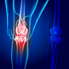 X-ray image of two hands holding knee showing knee joint injury on dark blue background. Used in medical and educational fields.