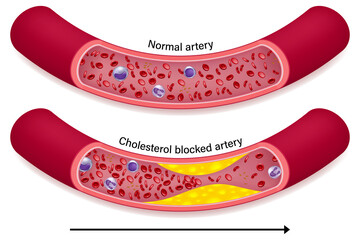 The difference of normal artery and cholesterol blocked artery. Clogged arteries caused by cholesterol. - obrazy, fototapety, plakaty
